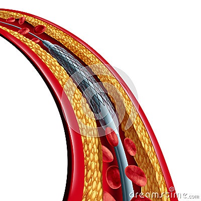 Coronary Stent Placement Isolated Cartoon Illustration