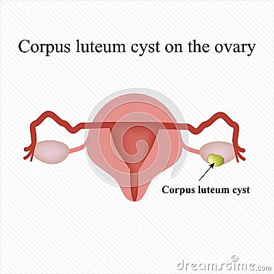 Corpus luteum cyst on the ovary. Functional . . Infographics. Vector illustration Vector Illustration