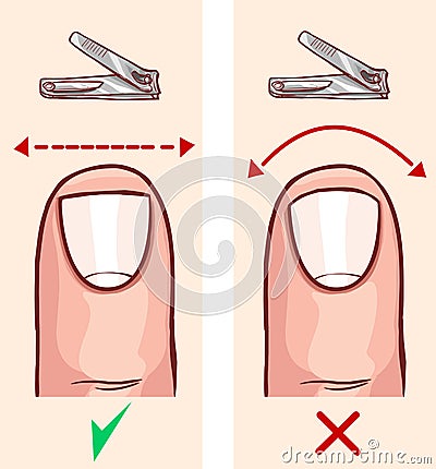 Correct and incorrect fingernail cut Vector Illustration