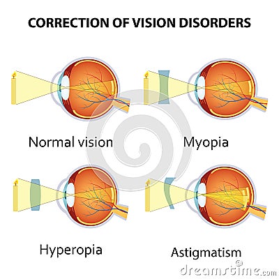 Correction of eye vision disorders by lens. Vector Illustration