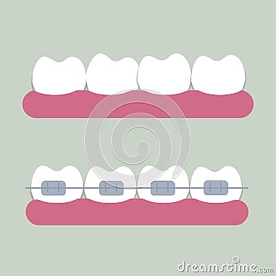 Correction of teeth with orthodontic braces. Dental clinic services. Vector illustration in flat style Cartoon Illustration