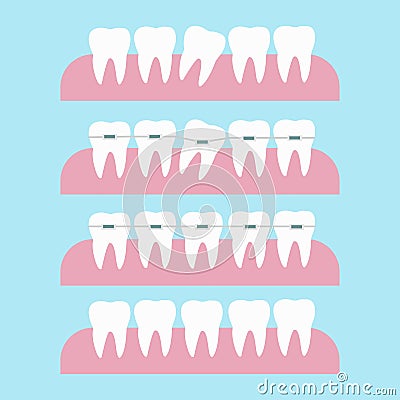 Correction of teeth with orthodontic braces. Tooth orthodontic treatment. Before and after braces tooth correction Cartoon Illustration