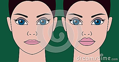 Correction of thin lips Vector Illustration