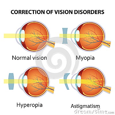 Correction of various eye vision disorder. Vector Illustration