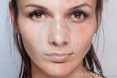 Before and after cosmetic operation. Young pretty woman portrait Stock Photo