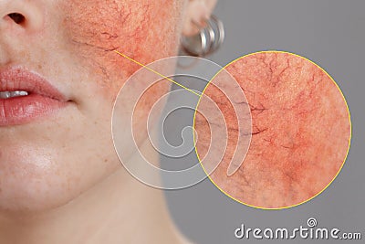 Cosmetology and rosacea. Close-up portrait of female face, cheeks with severe inflammation, blood vessels and rosacea Stock Photo