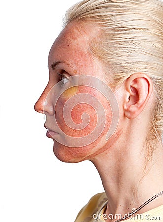 Cosmetology. Skin condition after chemical peeling Stock Photo