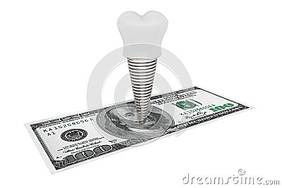 Cost of dental concept. Tooth Implant With Money Stock Photo