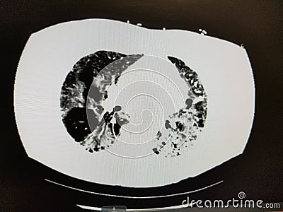 COVID-19 CT Scan of the Chest in patient with emphysema Stock Photo