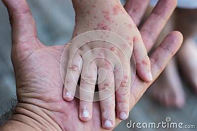 Coxsackie virus. Child with a skin rash. Stock Photo