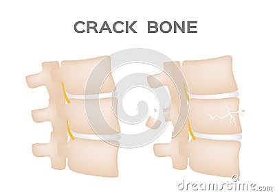Crack bone spine / broken and damaged disc Vector Illustration