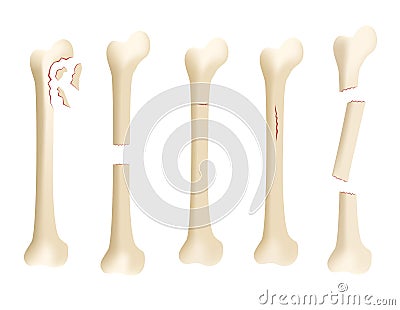 Crack human bone Vector Illustration