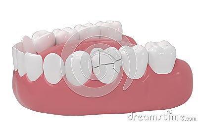 Crack tooth, tooth disease, 3d rendering Stock Photo