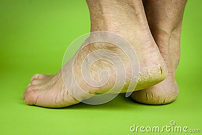 Cracked heels on green background Stock Photo