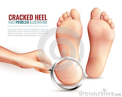 Cracked Heels Illustration Vector Illustration