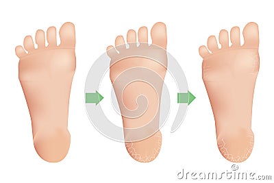 Cracked heels on white background Vector Illustration