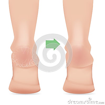 Cracked heels on white background Vector Illustration