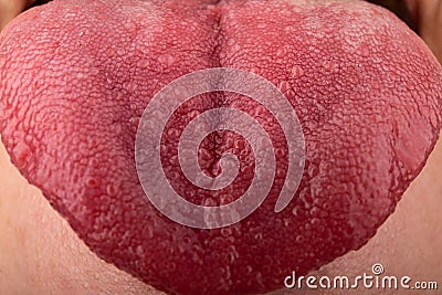 cracks in the tongue Candida diseases, red tongue stomatitis closeup Stock Photo