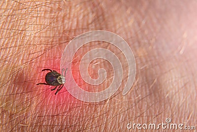 Crawling deer tick on the background of human hairy skin Stock Photo