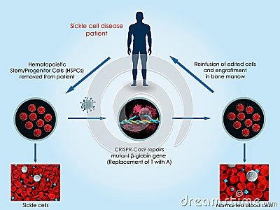 CRISPR-Cas9 to treat sickle cell disease Stock Photo