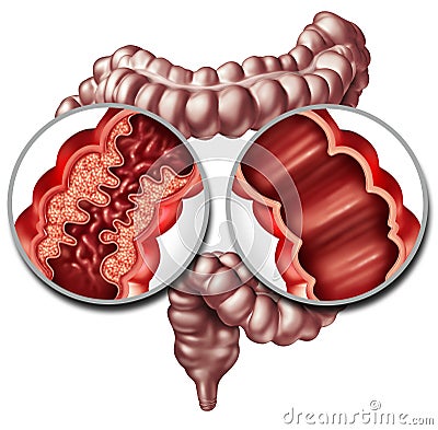 Crohn Disease And Healthy Intestine Cartoon Illustration