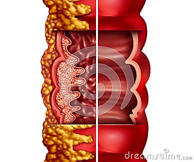 Crohn's Disease Cartoon Illustration