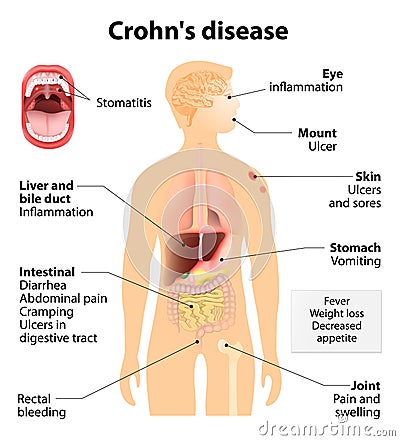 Crohn's disease or Crohn syndrome Vector Illustration