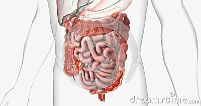 Crohns disease is a type of chronic inflammatory bowel disease Stock Photo