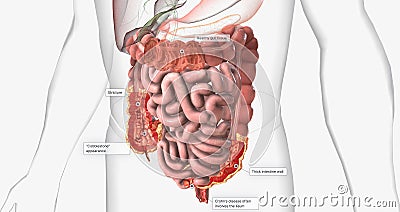 Crohns disease is a type of chronic inflammatory bowel disease Stock Photo