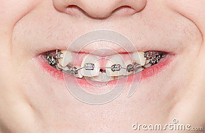 crooked growing teeth after visiting the dentist and installing braces Stock Photo