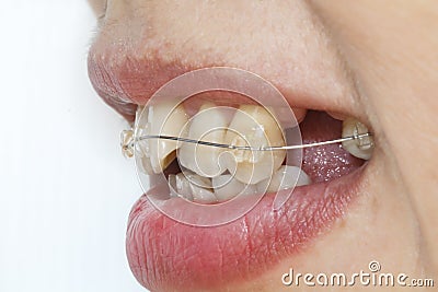 Crooked teeth with braces. Stock Photo