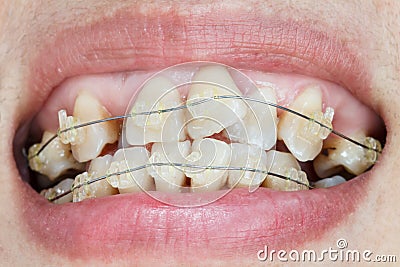 Crooked teeth with braces. Stock Photo