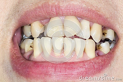 Crooked teeth before braces Stock Photo