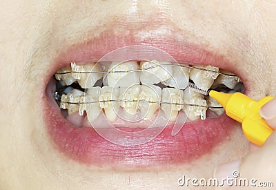 Crooked teeth with braces, interdental brushing Stock Photo