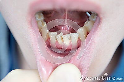 Crooked teeth on the lower jaw, crowding of teeth in the anterior part, crowded Stock Photo