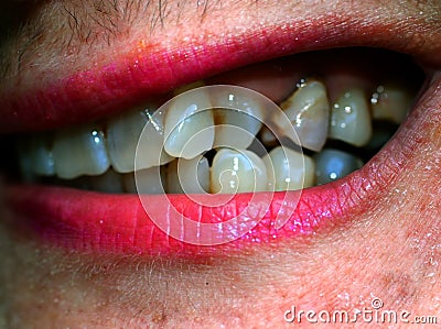 Crooked teeth in the mouth. Orthodontics. Malocclusion. Stock Photo