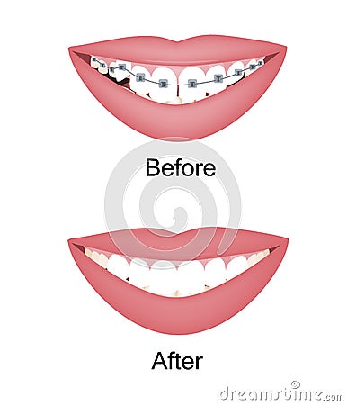 Crooked woman teeth before and after the orthodontic treatment with braces. Vector illustration isolated set Vector Illustration