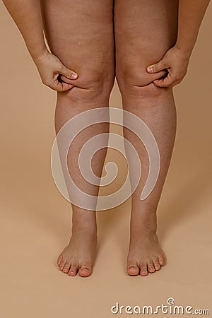 Cropped photo of woman bare naked legs, pinching fat on knees. Clipping fat folds. Body care. Fat pumping. Varicose skin Stock Photo