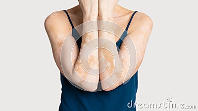 Cropped of woman with skin condition loss of melanin Stock Photo