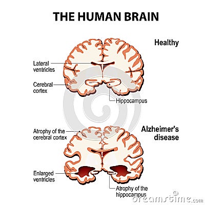 Cross-section of the human brain with Alzheimer`s disease Vector Illustration