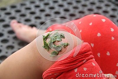 crushed binahong leaves attached to the leg of an injured child. Binahong leaves are fast in wound healing. Stock Photo