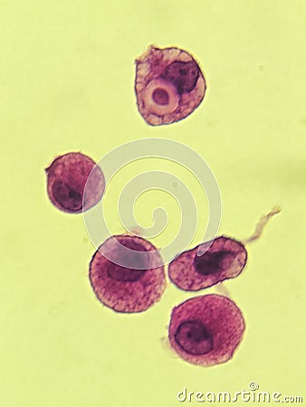 Crytpococcus neoformans encapsulated organism inside macrophage - CSF smear Stock Photo