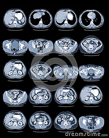 CT Abdomen Stock Photo