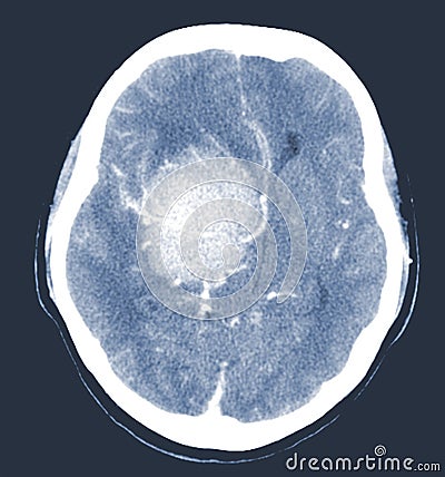 CT Brain Axial scans hyperdense mass with homogeneous, and mild perilesional brain edema at the right front-temporal-parietal Stock Photo