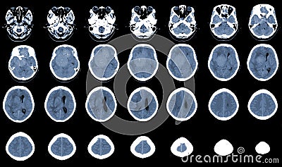 CT Brain Axial scans hyperdense mass with homogeneous, and mild perilesional brain edema at the right front-temporal-parietal Stock Photo