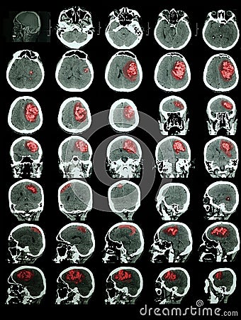 CT of the brain with hemorrhagic stroke Stock Photo