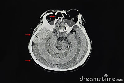 A CT brain scan of a patient with multiple fractures, epidural hematoma, and pneumocephalus Stock Photo