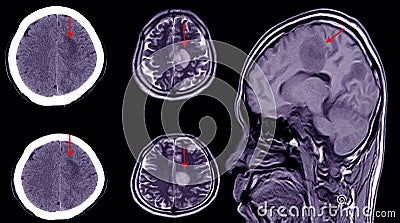 CT brain scan of a patient with history of mild head injury showing large subacute subdural hematoma Stock Photo