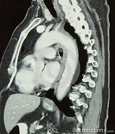 CT of Chest Stock Photo