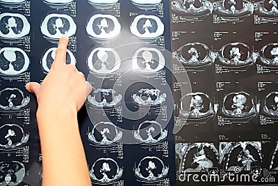 CT computed tomography of lung, pulmonary embolism PE, pneum Stock Photo